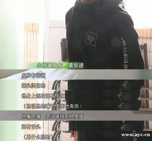 广州一七岁男孩疑遭父母虐待，满身烟头烫，双手被烧伤，恐将截肢