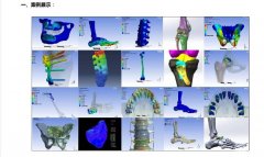深圳abaqus骨科口腔生物力学分析项目承接