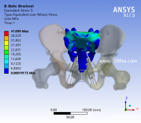 医学骨科有限元分析