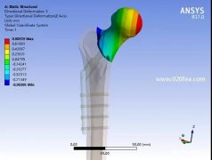医学骨科有限元分析