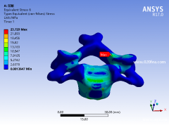 医学骨科有限元分析