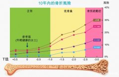博力加?「仿保骨素针」助你对抗骨质疏鬆