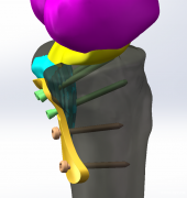 广州Mimics培训骨科有限元分析培训