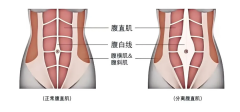 产后康复——重塑腹部线条