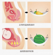 产后盆底肌修复的重要性及好处