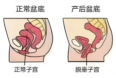 科学产后康复：重焕女性健康活力
