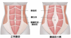 产后肚子隆起、皮肤松弛？可能是腹直肌分离！