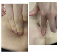 产后腹直肌高于几指才需要做腹直肌修复？