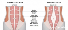 告别“小腹婆”，从修复腹直肌开始！