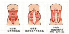 产后腹直肌修复的核心关键是什么？