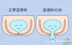 盆底肌：女性健康不可或缺的守护者