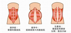 ​​夏日修复产后问题正当时：腹直肌修复从现在开始​​