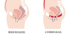 ​​难以言说的隐痛——女性盆底健康的秘密