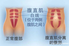 产后康复不是“矫情”：理解腹直肌分离，给身体温柔的修复