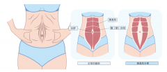 腹直肌分离：产后妈妈的隐形挑战与科学应对