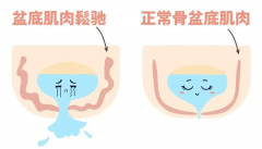 产后别只关注身材，盆底肌修复更重要！