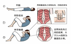 女生小肚子突出？警惕腹直肌分离！