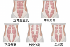 女生小肚子突出？警惕腹直肌分离！