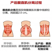 想要产后重塑平坦小腹？你应该做到这5件事
