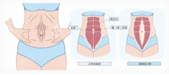 产后妈妈的大困扰：肚子松松垮垮？可能是腹直肌分离在作怪！