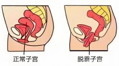 产后妈妈必存！盆底肌问题分型修复宝典​