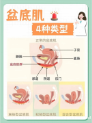 产后妈妈必存！盆底肌问题分型修复宝典​