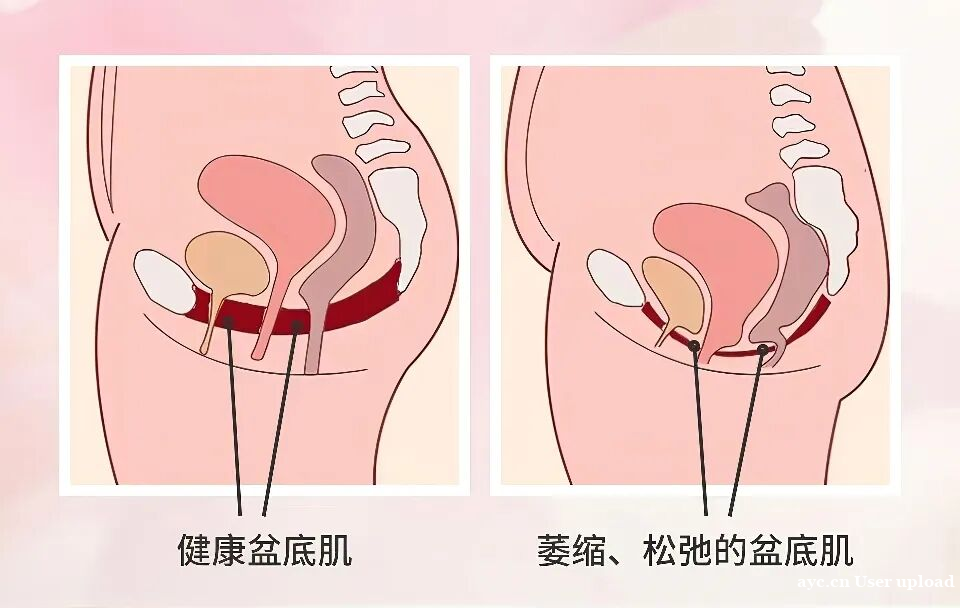 女性必练!强化盆底肌的完整指南,告别小腹凸出和臀部下垂 女性必练!强化盆底肌的完整指南,告别小腹凸出和臀部下垂