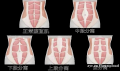 科普 | 腹部松弛？可能是“腹直肌分离”在作怪