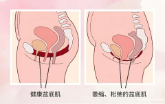 女性必练！强化盆底肌的完整指南，告别小腹凸出和臀部下垂