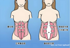 我与腹直肌分离的和解之路：遇见易舒美修复仪