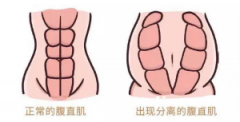 产后康复黄金期：盆底肌+腹直肌修复全攻略