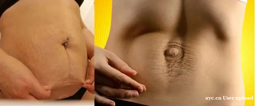 生完宝宝肚子中间有条“沟”?腹直肌分离修复全攻略 生完宝宝肚子中间有条“沟”?腹直肌分离修复全攻略