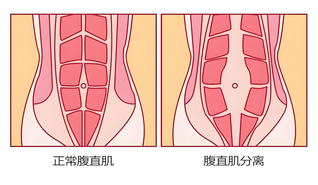 生完宝宝肚子中间有条“沟”?腹直肌分离修复全攻略 生完宝宝肚子中间有条“沟”?腹直肌分离修复全攻略