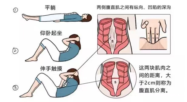 产后肚子松垮难恢复?可能是腹直肌分离在作怪! 产后肚子松垮难恢复?可能是腹直肌分离在作怪!