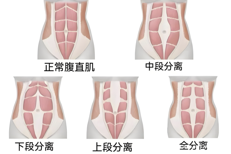 女生小肚子突出,要警惕这种情况(不是肥胖) 女生小肚子突出,要警惕这种情况(不是肥胖)