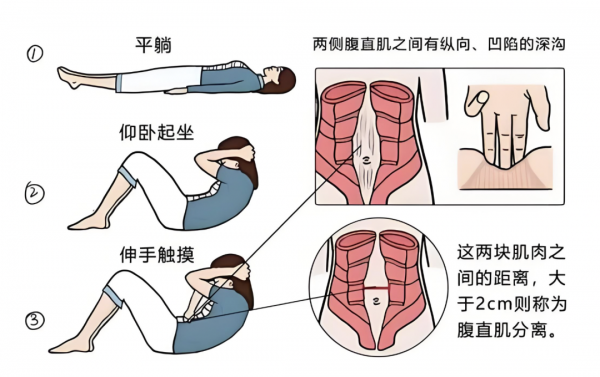 女生小肚子突出,要警惕这种情况(不是肥胖) 女生小肚子突出,要警惕这种情况(不是肥胖)