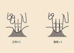 超过60%产后女性都在为这件事烦恼！腹直肌分离修复试试这个办