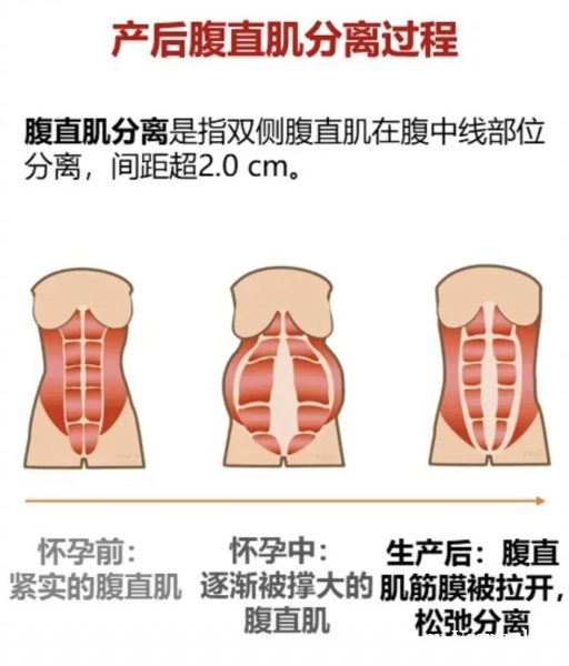 产后瘦身总卡关?不是你不努力,是盆底与腹直肌没修复! 产后瘦身总卡关?不是你不努力,是盆底与腹直肌没修复!