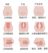 别硬扛！产后这些难言之隐，易舒美帮你轻松破解