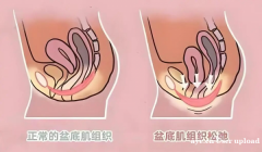 产后不止是"瘦身"：盆底